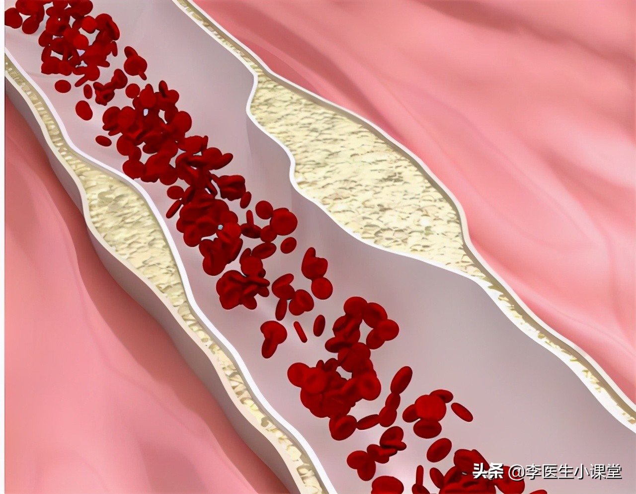 预防脑梗怎么补充叶酸和维生素b12,老年人补充叶酸预防脑梗有讲究