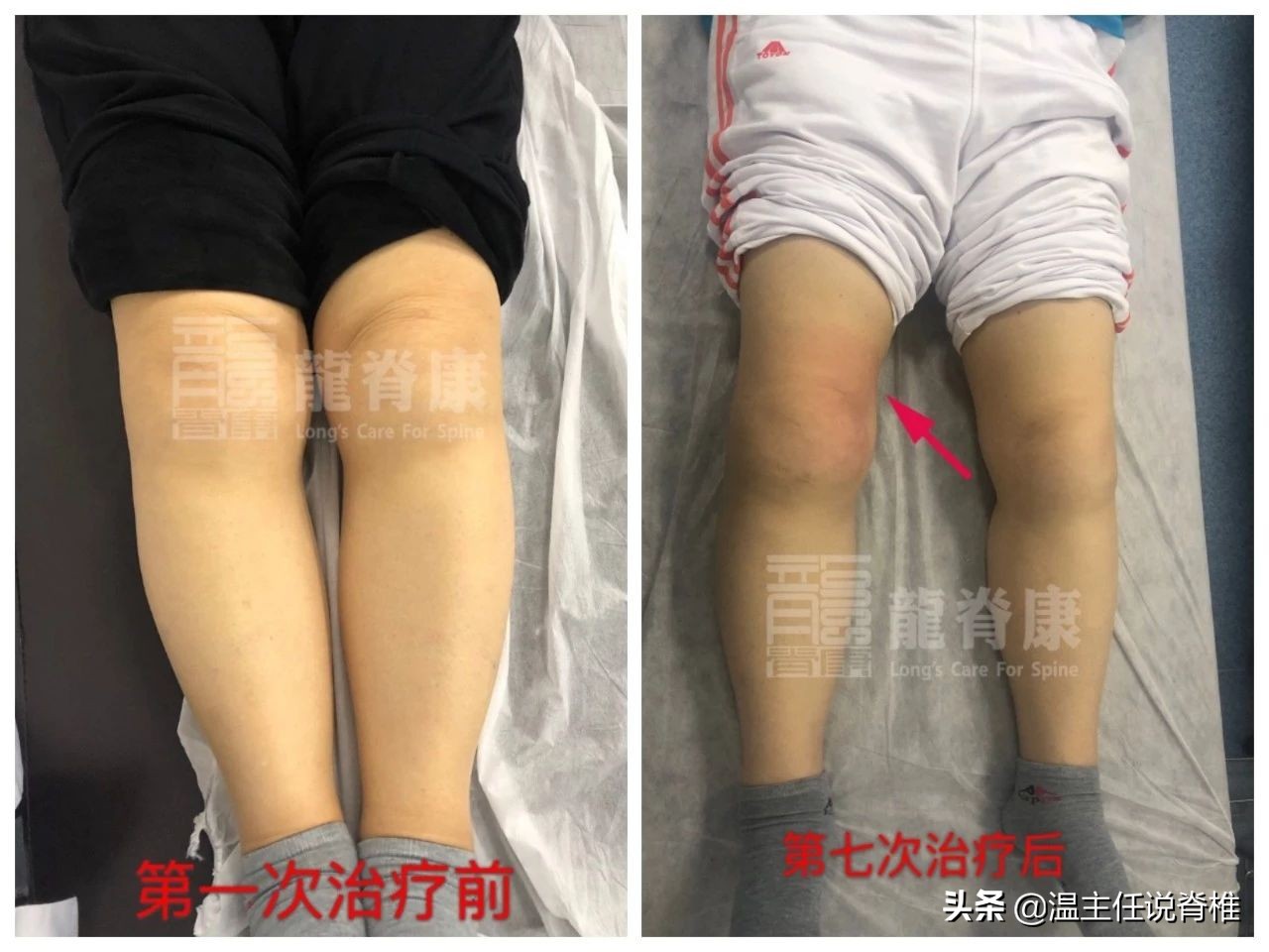 治多种腰痛的方法,腰痛转移到膝盖痛怎么治疗