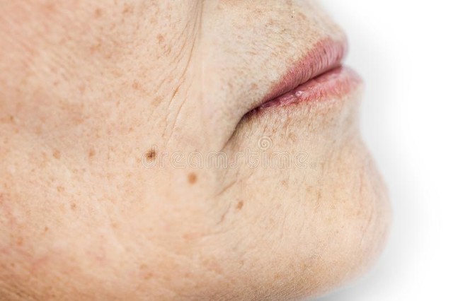 生姜擦脸可以祛斑祛痘吗,生姜擦脸能祛斑祛痘吗