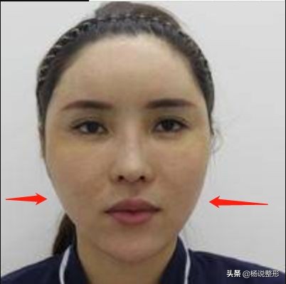 20岁面部凹陷如何改善,脂肪填充面部凹陷怎么导致的呢