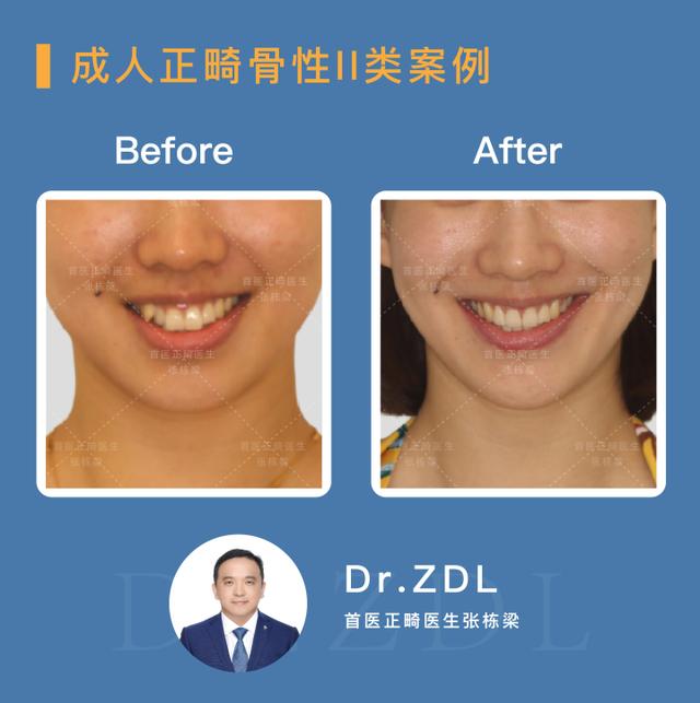 骨性龅牙做正畸还是正颌,骨性龅牙正颌手术前要正畸吗