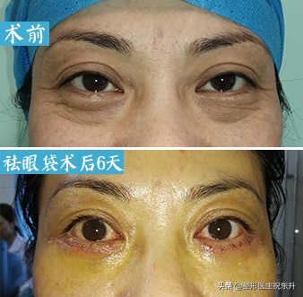 祛眼袋后眼袋出现皱纹怎么办,祛眼袋后凹陷怎么办