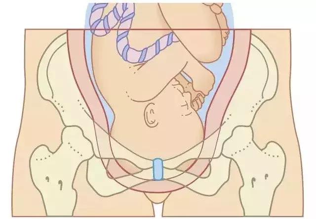 必须很遗憾的说：这几类准妈妈只能剖着生，看看有没有你？