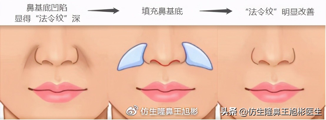 隆鼻鼻型科普,鼻基底凹陷隆鼻可以改善吗