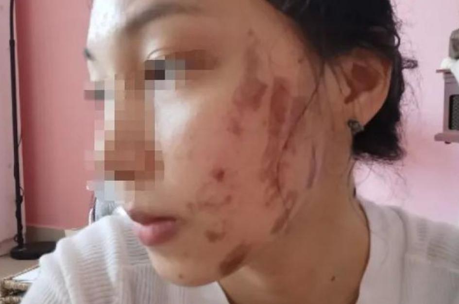 女子做完光子嫩肤后脸上全是黑疤,做完光子嫩肤后怎么黑了