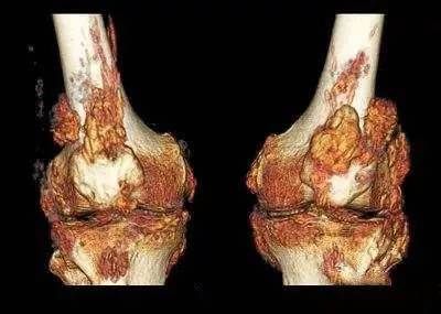 痛风发作期苯溴马隆的正确吃法,痛风治疗专家讲解