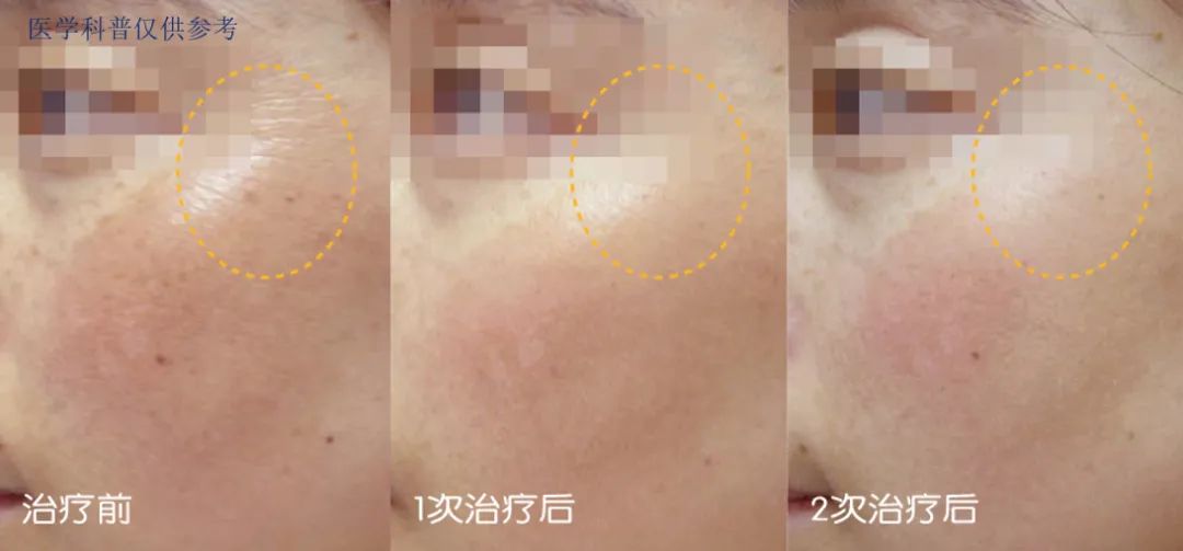 明星都在做的医美,光电光子嫩肤