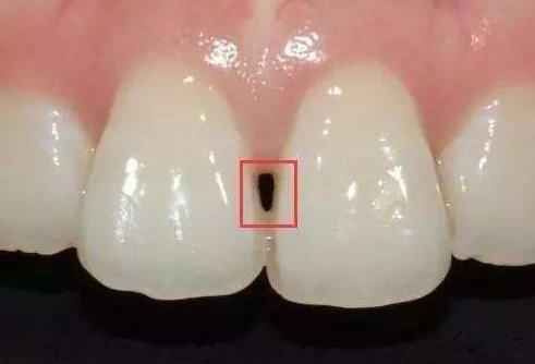 牙齿有黑线就证明里面坏了吗,牙齿有黑渍一定是龋齿吗