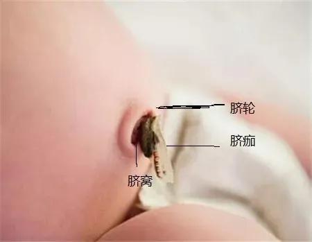脐部护理的介绍,新生儿脐部护理