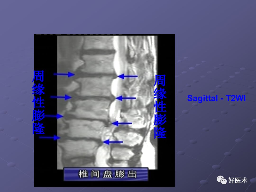 脊柱mri有哪些特点,乳腺疾病的mri诊断及鉴别