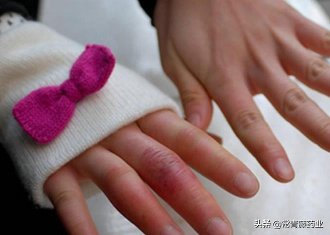 南方人到北方预防冻疮的有效方法,南方人冬天的冻疮是什么样子的