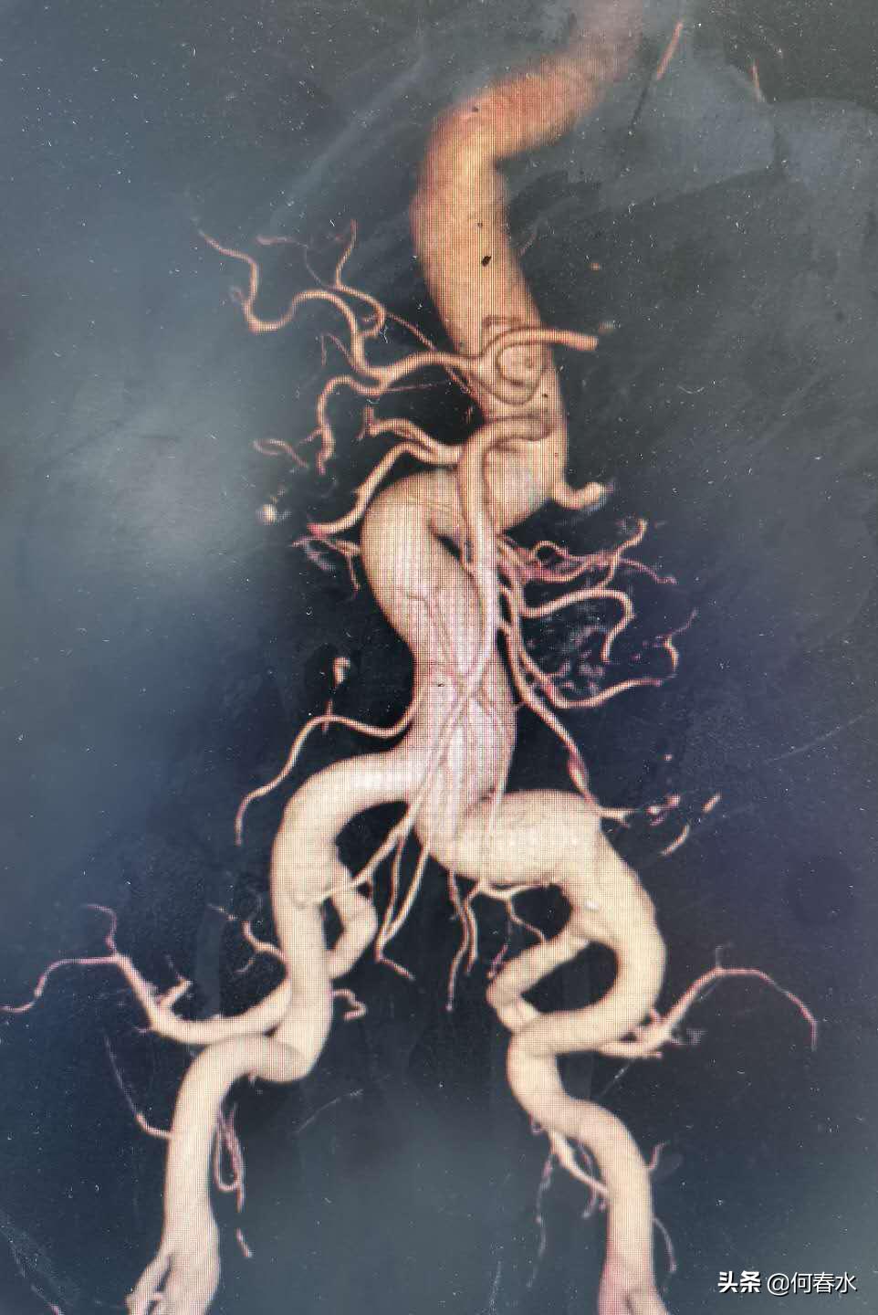 腹主动脉血管瘤需重视早期干预,医院成功救治主动脉夹层患者