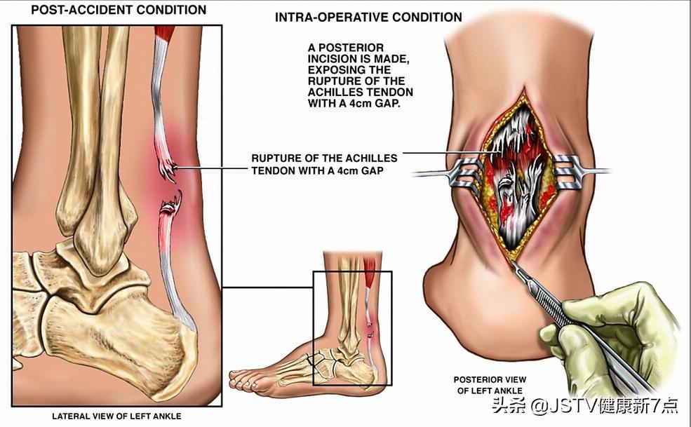 爱“足”常乐，骨科专家教你减轻四大“足”痛