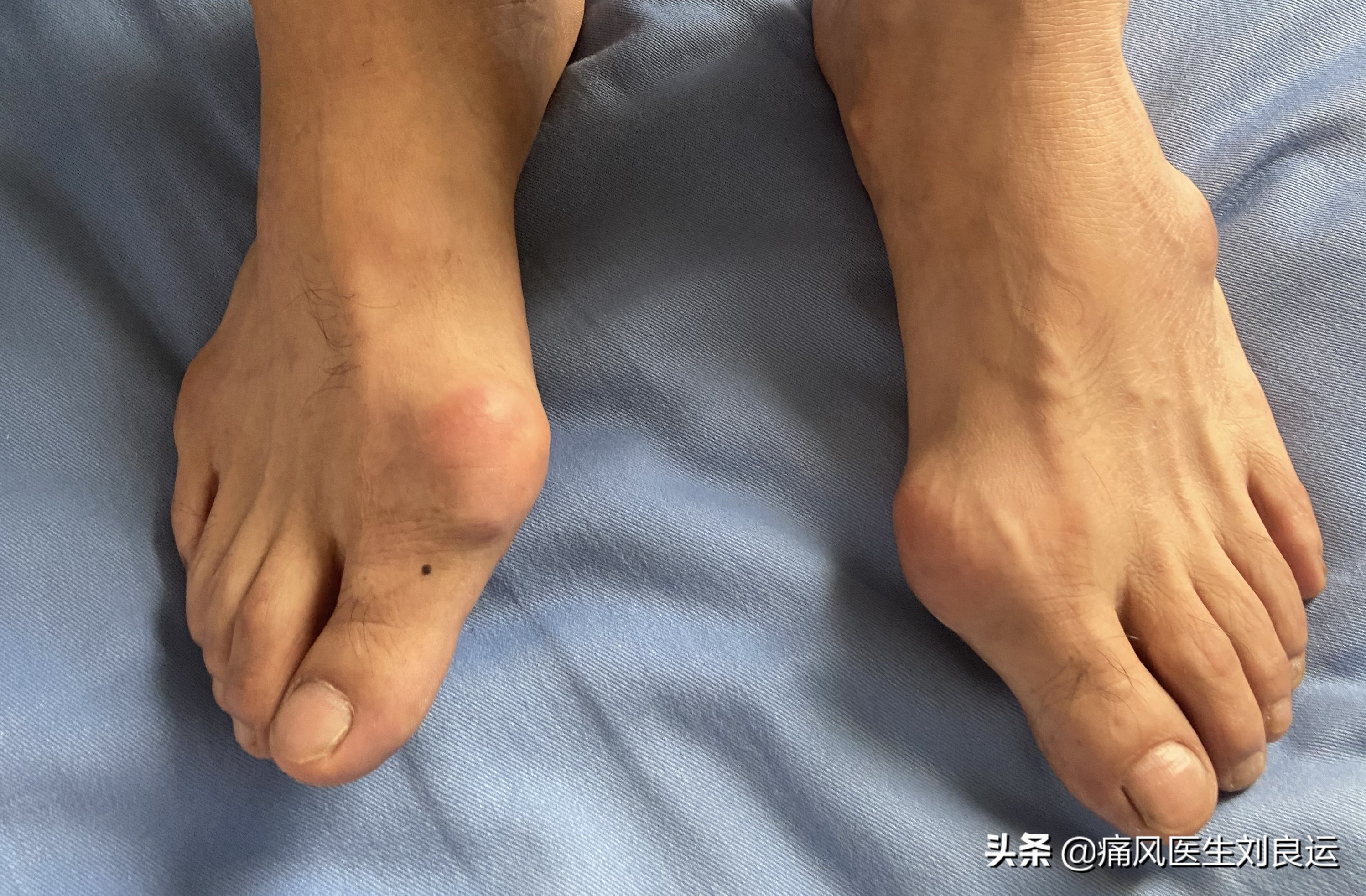 降尿酸到底能不能溶解痛风结晶,降尿酸时痛风发作怎么办