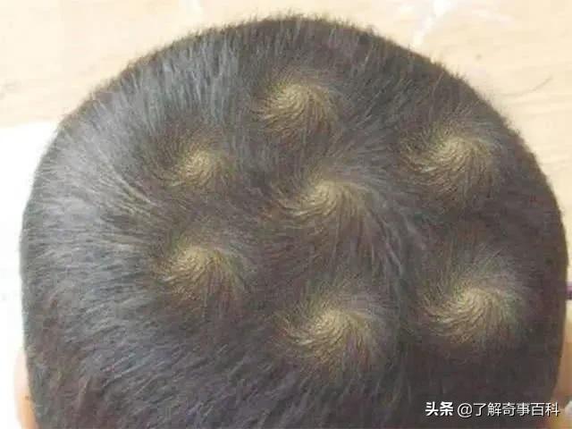 孩子头顶太多旋,孩子头顶有2个旋到底代表啥