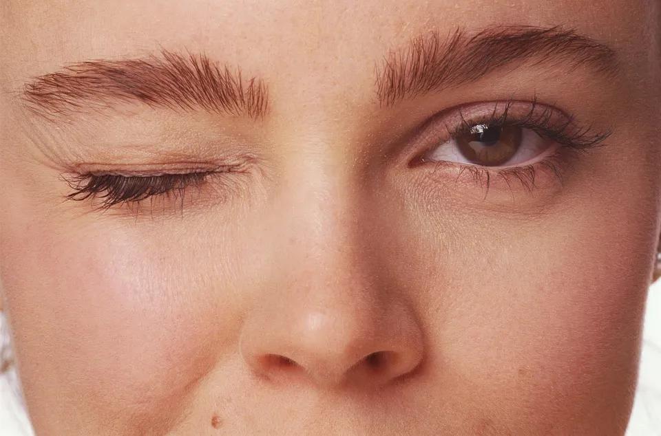 面肌痉挛通过合理习惯可以自愈吗,如何治疗面肌痉挛