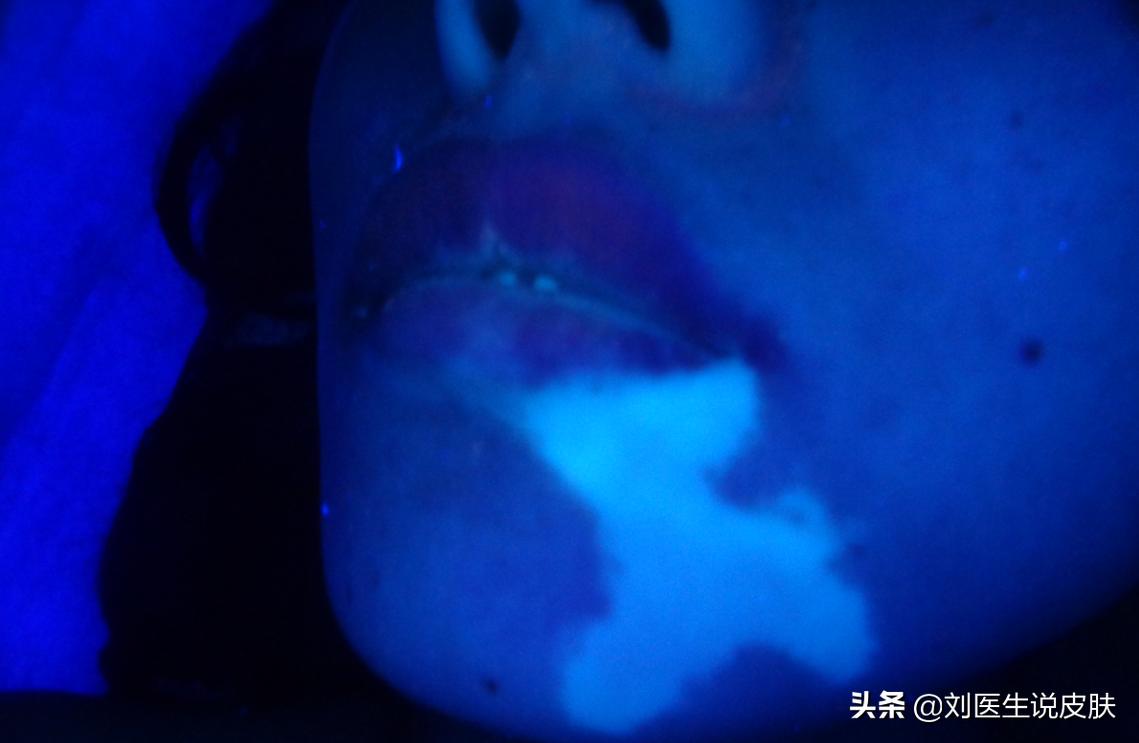 23岁女孩白癜风怎么治疗,29岁女人白癜风自愈