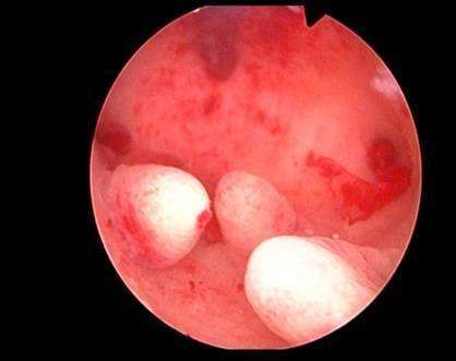 月经老是不干净,警惕内膜病变