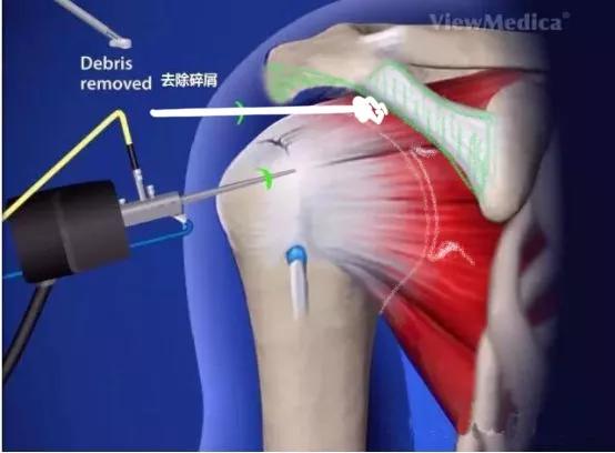 肩袖损伤和肩周炎粘连,肩袖损伤肩周炎冻结肩