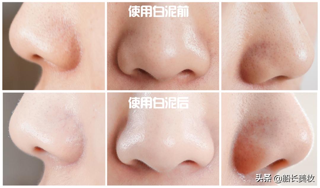 不用泥膜如何去脸上的脏东西,如何快速清理脸上的黑泥