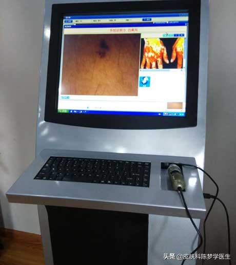 一次激光点痣会导致癌变吗,激光点痣会诱发痣癌变是真的吗