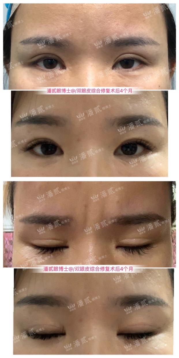 双眼皮太深显老怎么修复,双眼皮失败后修窄