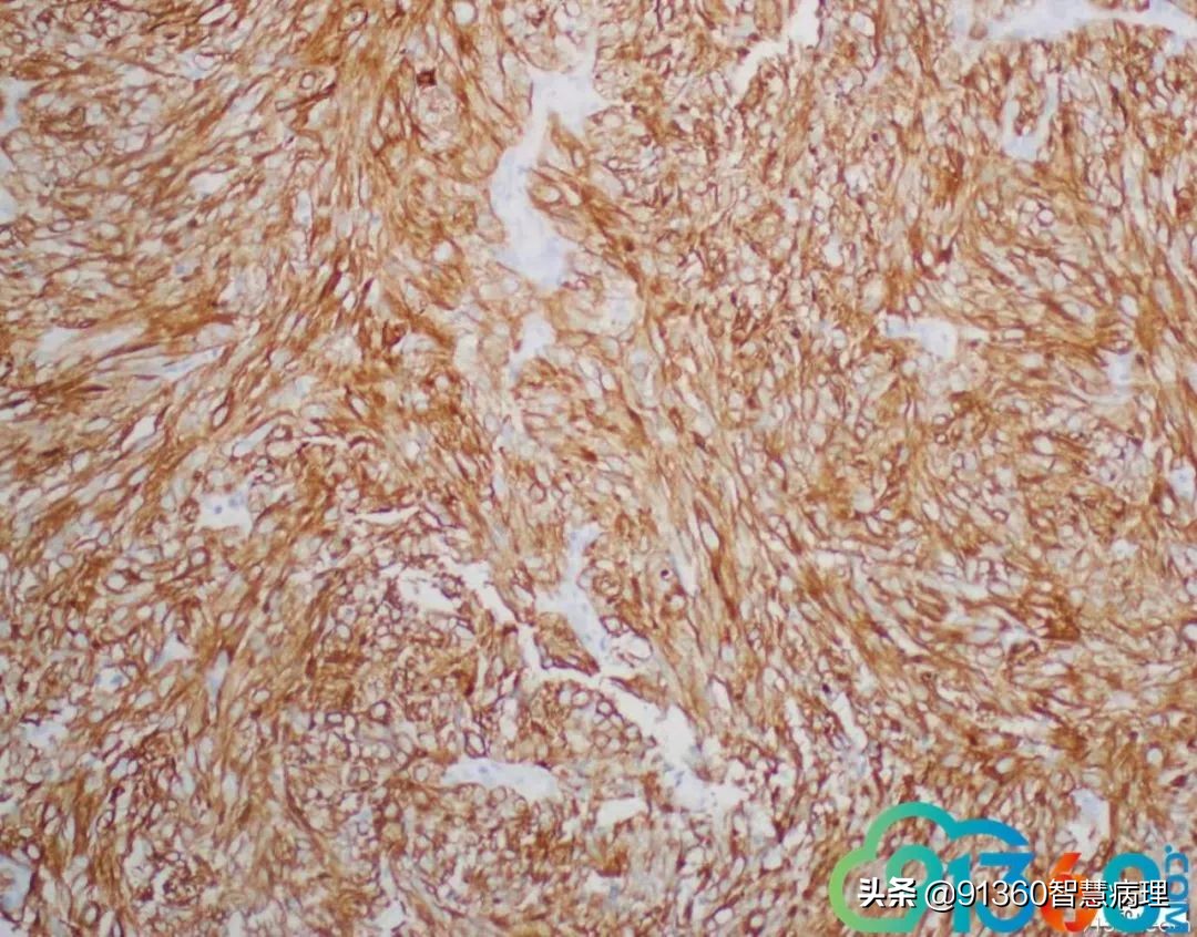 宫颈腺癌silvaa型严重吗,宫颈腺癌silvab型复发率高吗