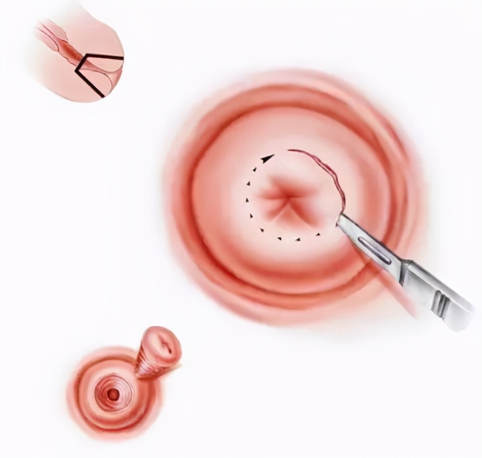 浸润性宫颈癌需要化疗吗,浸润性宫颈癌没转移一般能活几年