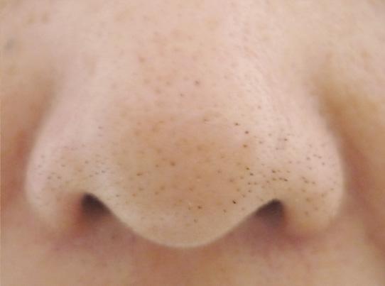 缩小毛孔的最有效方法是什么,缩小毛孔最有效的方法是什么