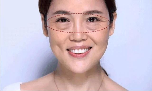 眼袋越来越严重怎么救,有眼袋显老十岁一招教你消除