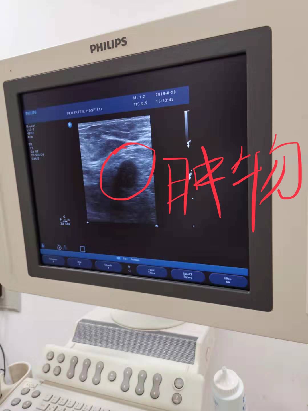 乳腺活检穿刺一般需要多少时间,乳腺bi-rads4b穿刺活检怎么做