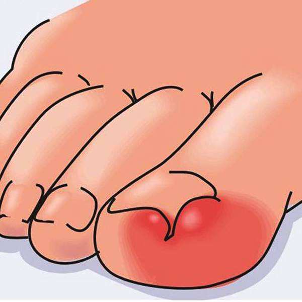 甲沟炎治好了以后怎么防止复发,甲沟炎的预防及有效处理方法