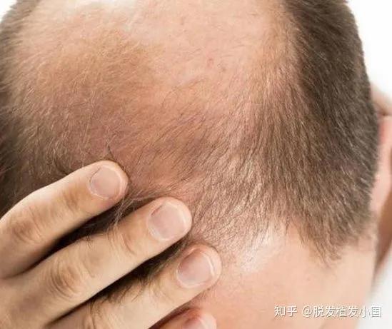 中医脱发挂哪个科室,脱发中医看哪个科室