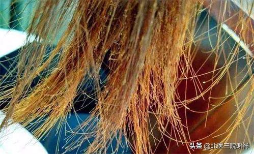 怎么分辨脱发的类型,脱发原因有几种类型