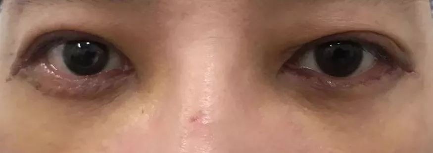 眼袋消除三个方法,教你一个简单消除眼袋的方法