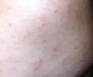 拯救痘痘烂脸用什么药,拯救痘痘烂脸这个小窍门你知道吗