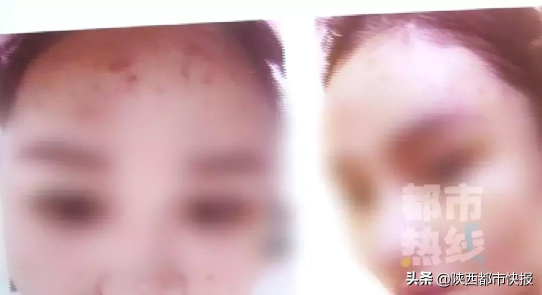 女子打童颜针修复,一女子打瘦脸针毁容