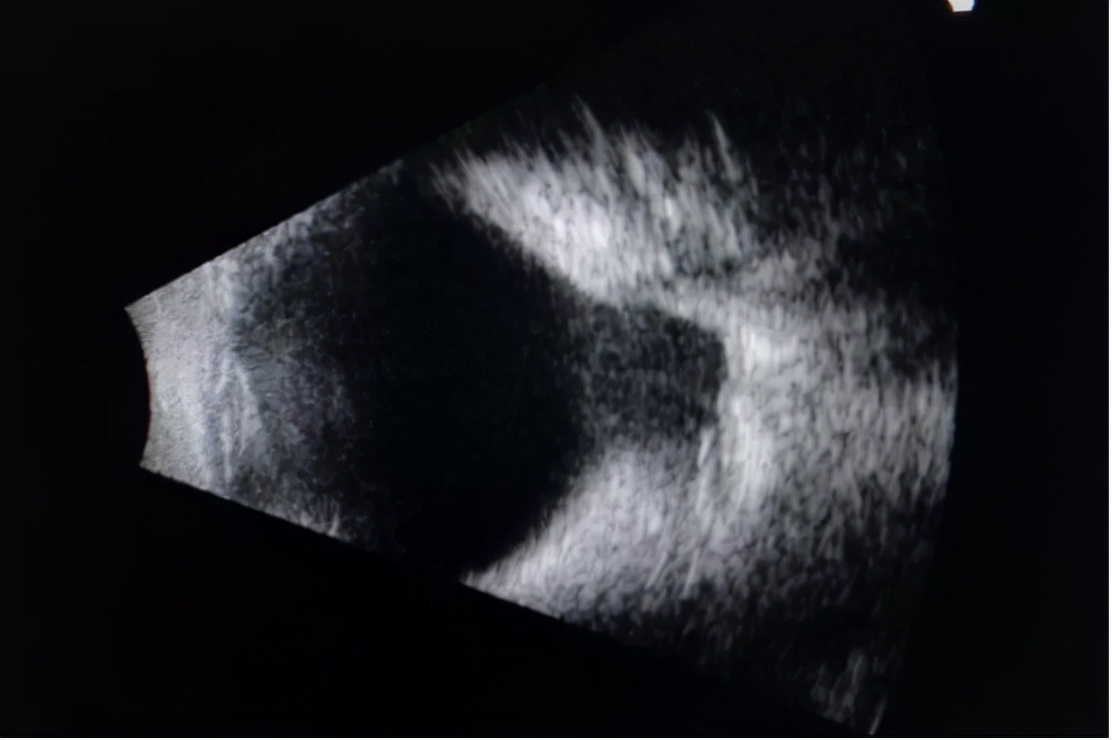 十三岁高度近视能做巩膜加固术吗,后巩膜加固术提高视力