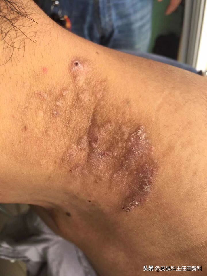 真菌感染性皮肤病原因,人真菌皮肤病怎么治