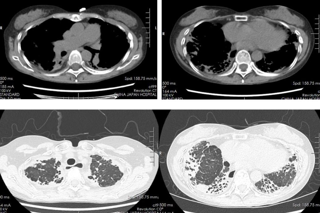 肺动脉高压患者咳嗽有血去哪治疗,肺动脉高压患者能进行呼吸康复吗