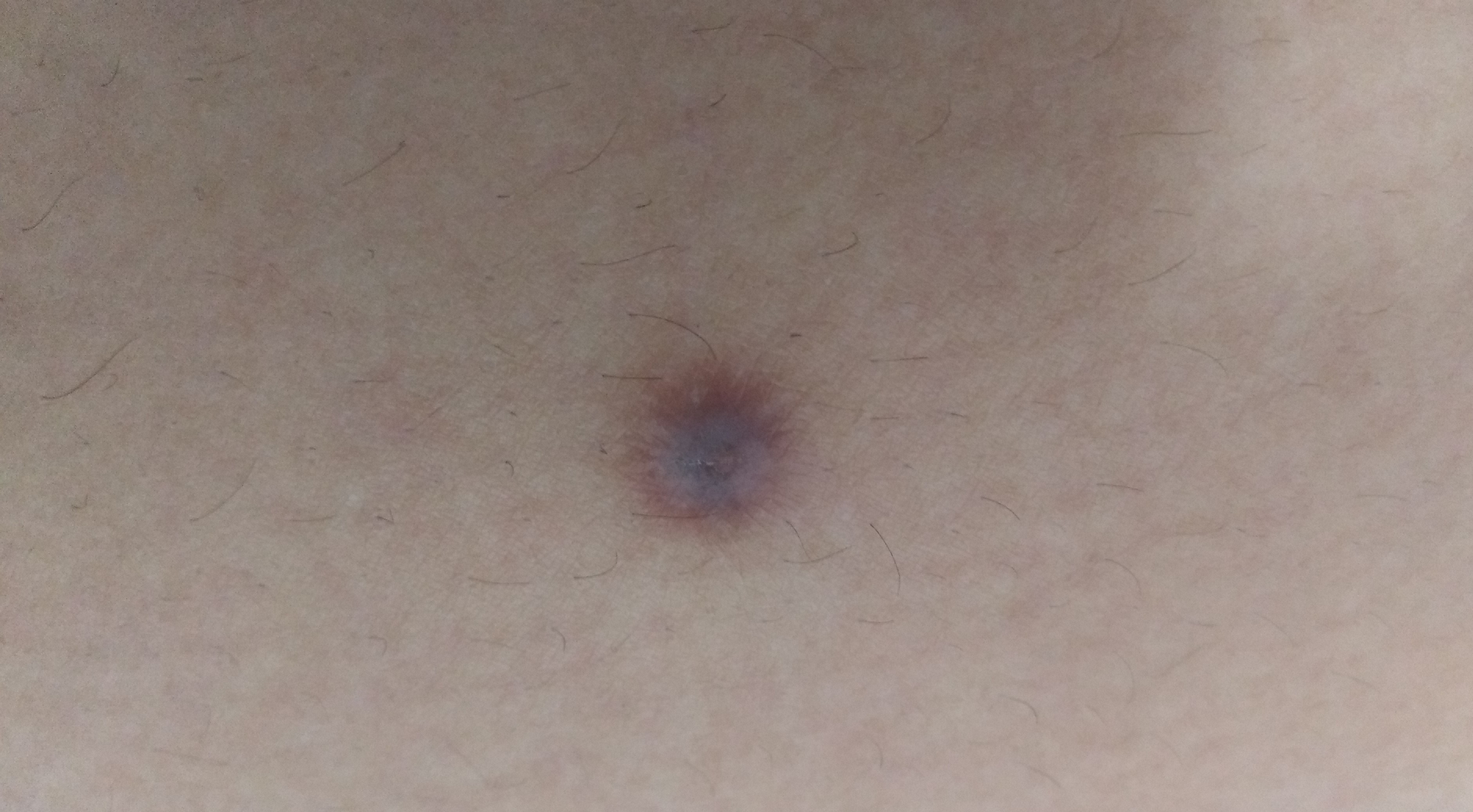 皮肤表面有个深褐色很硬的肿块？别担心，可能是皮肤纤维瘤