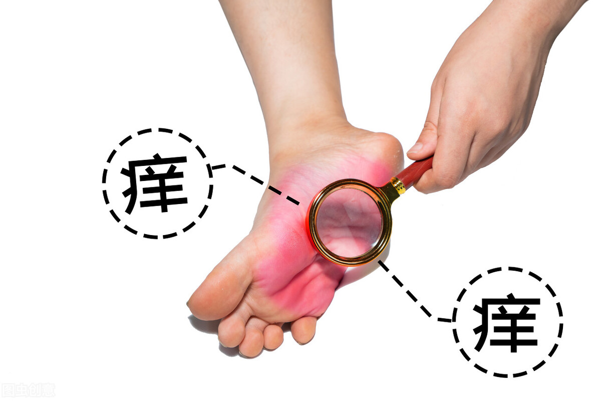 足癣不是真菌感染怎么治,足癣怎么治疗好得快