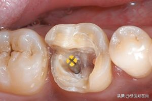 牙齿缺损非常少补牙后容易掉吗,牙齿掉了直接镶一颗吗