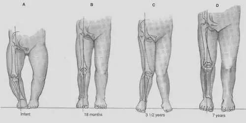 如何判断腿直不直,小孩腿不直怎么纠正腿型