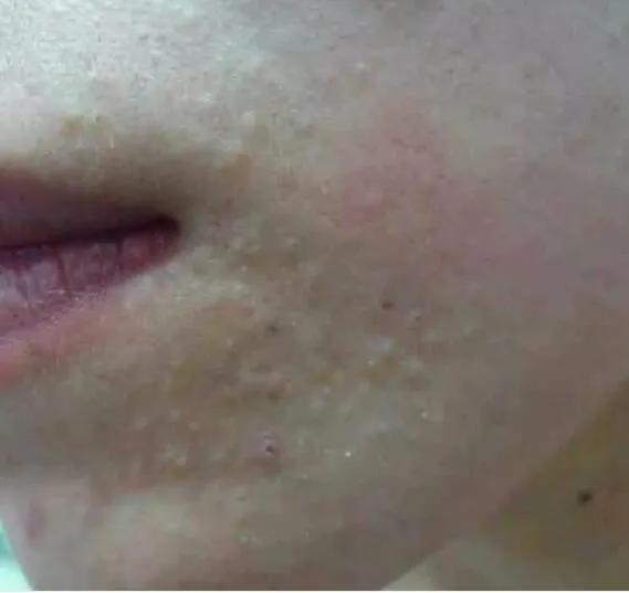 带你了解闭口的出生到消失，教你如何把闭口扼杀在摇篮里