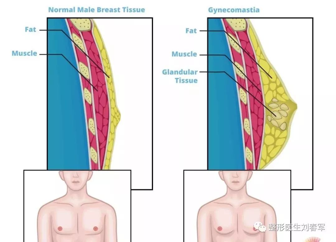 男性胸发育了怎么办,男性胸部发育了怎么办