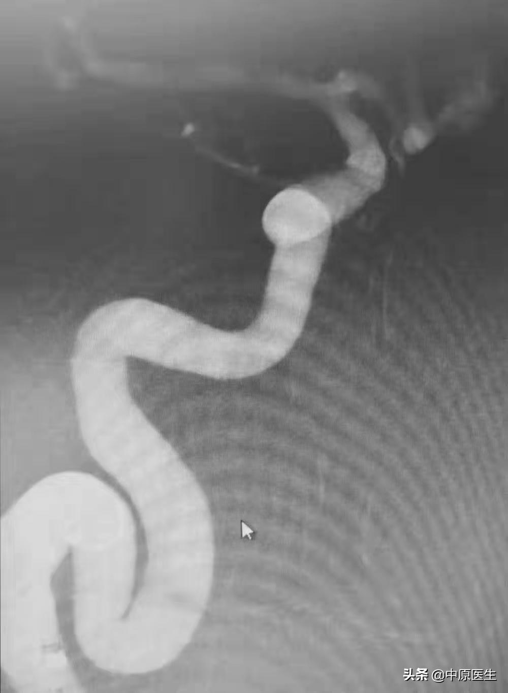 大脑双侧动脉瘤,发现脑内有两个瘤医生说不管