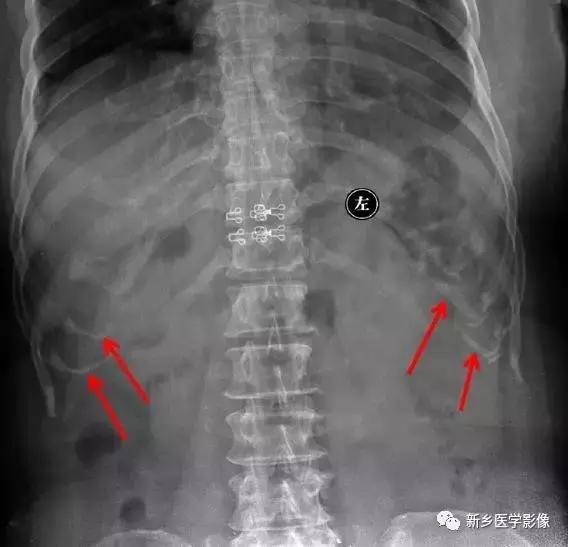 腹部平片能看到结石吗,腹部高密度结节影是什么