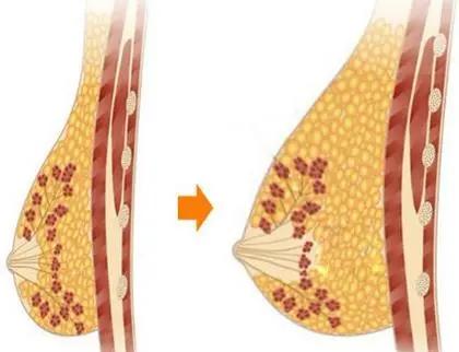 自体脂肪隆胸两年后的忠告,平胸可以做自体脂肪隆胸吗