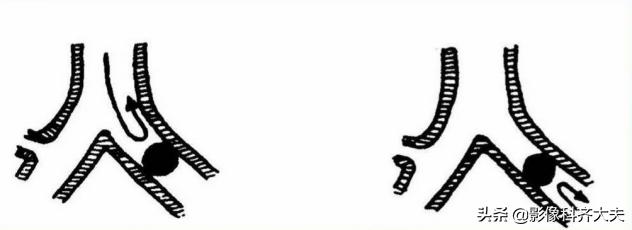 孩子支气管异物ct能查出吗,儿童支气管异物诊断方法